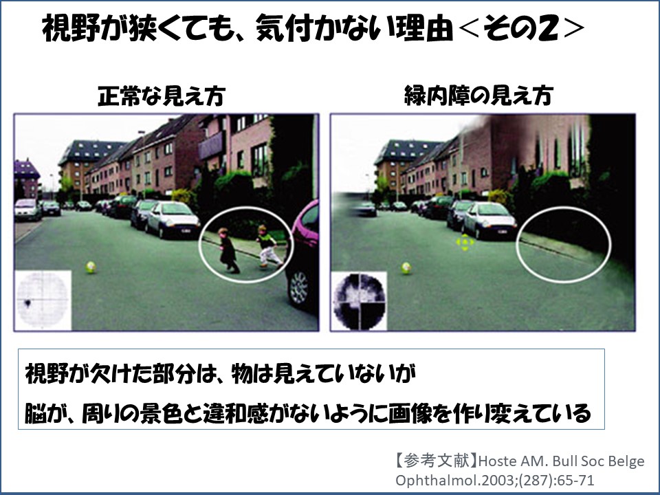 症状がないのに 緑内障ですか その１ 視野狭窄に気が付かない まつもと眼科