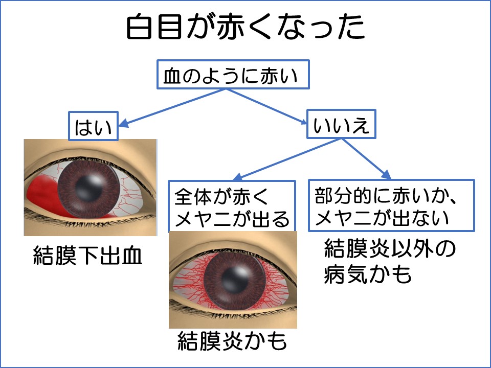 白目が赤くなる病気とは まつもと眼科 公式サイト 下関市東駅で日帰り白内障手術