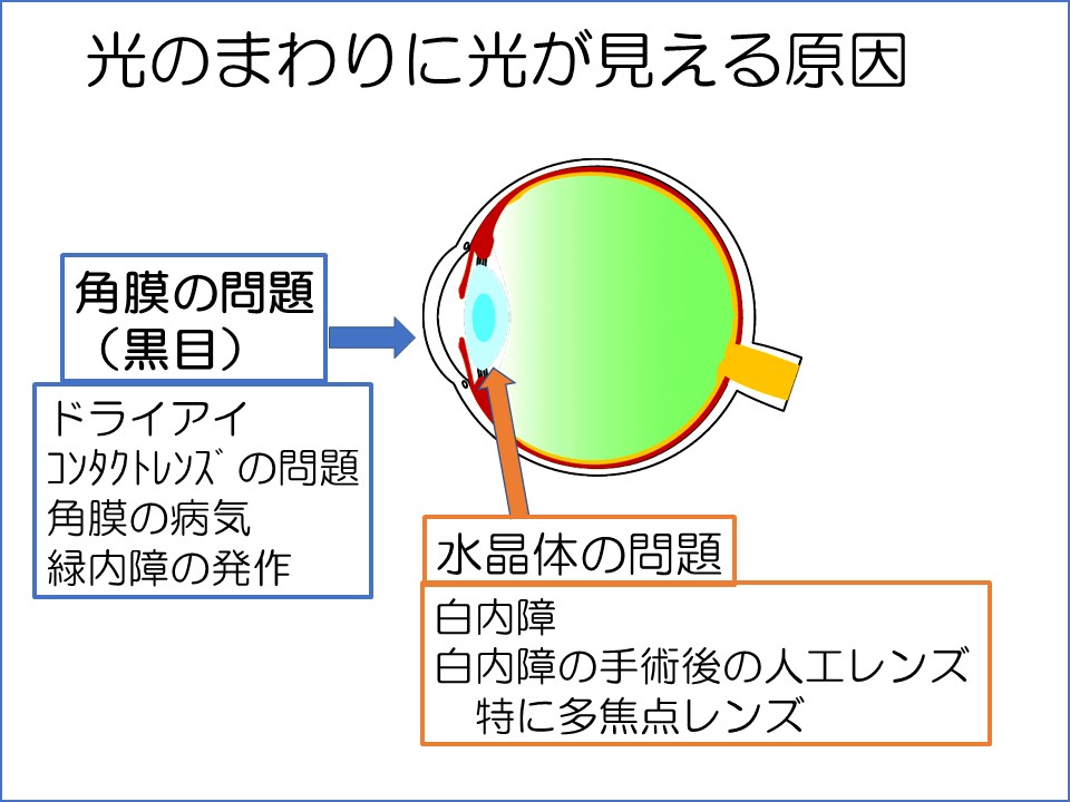 光のまわりに何か見える まつもと眼科 公式サイト 下関市東駅で日帰り白内障手術