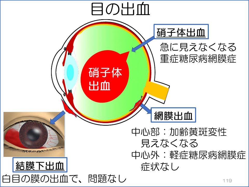 眼底出血