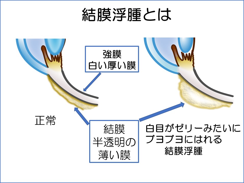 白目がゼリーみたいにブヨブヨになった まつもと眼科 公式サイト 下関市東駅で日帰り白内障手術