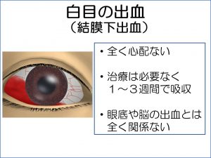 白目が血のように真っ赤になった:結膜下出血 | まつもと眼科