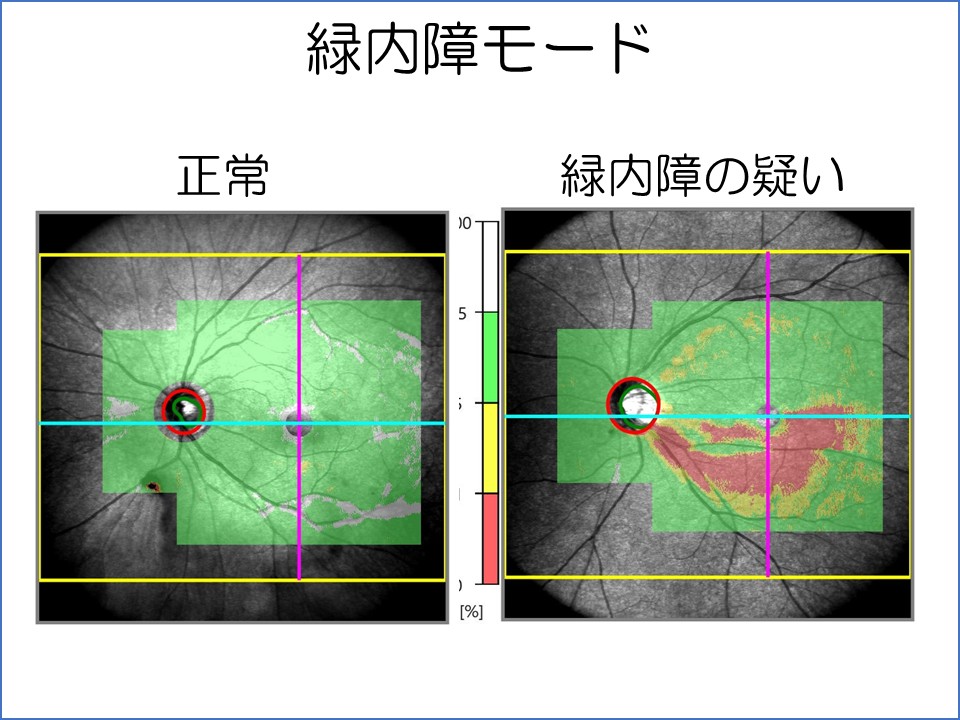 必見!! 希少 Optovue オプトビュー LENS レンズ CAM-S CAM-L 光干渉 